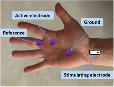 Motor Unit Number Estimation of the Second Lumbrical Muscle in Human Hand